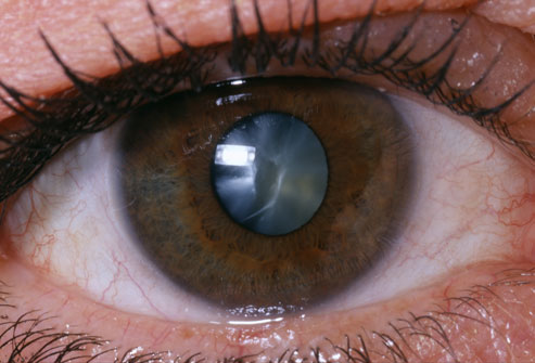 prevenir-cataracte et lentlles de contact